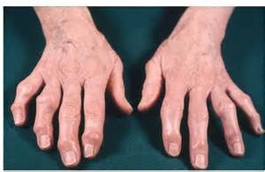 Артроза на малките стави на симптомите на ръце пръстите, как да се отнасяме хората средства, гимнастика, упражнения