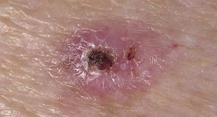 Базално-клетъчен карцином на кожата симптоми, лечение и отстраняване на народната медицина