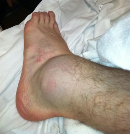 Болка в левия крак причини, свързани симптоми, лечение