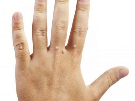 Брадавица на пръста си - как да се отърве от причините и лечението (снимка)