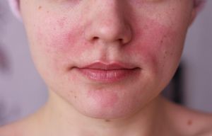 Че това е кожата кърлеж причини за дадено лице, симптомите на кърлеж подкожно на лицето и лечение