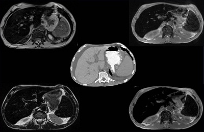 Какво прави ЯМР на черния дроб и е по-добре да се направи CT или MRI