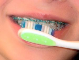 Какво е скоба върху зъбите как да се сложи, колко са скоби преди и след инсталацията