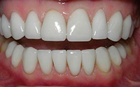Ckoby на зъбите - показания и противопоказания за монтаж