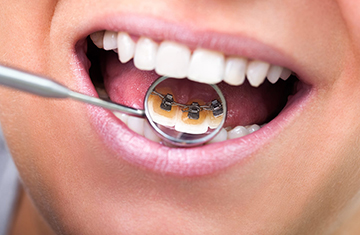 Ckoby на зъбите - показания и противопоказания за монтаж