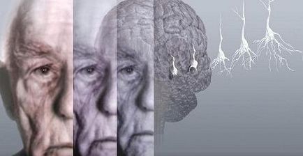 Деменция - това, което е сенилност