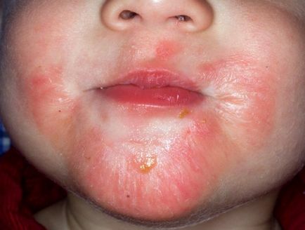 Дерматит при деца, лечение, симптоми, прояви, всичко за алергия