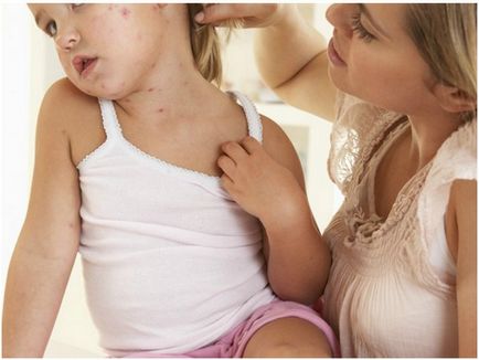 Диета за алергии в забраните и препоръките на детето