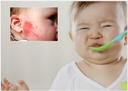 Диета за алергии в забраните и препоръките на детето