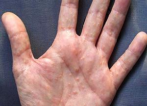 Dyshydrosis ръцете причини, лечение, профилактика