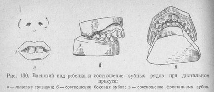 дисталния (prognathic) корекцията ухапване и последиците