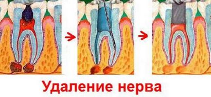 Какво арсен в зъба - действието и употребата на арсен