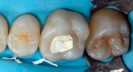 Какво арсен в зъба - действието и употребата на арсен