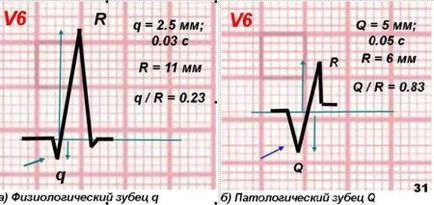 ЕКГ дете (деца) ЕКГ дете