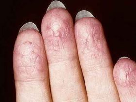 Екзема на пръстите основни типа дерматози, особено симптоми и лечението