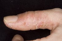 Екзема на пръстите причинява и лечения