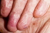 Екзема на пръстите причинява и лечения