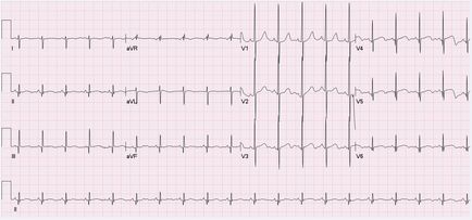 Eos (електрически ос на сърцето) и отклонение на позиция
