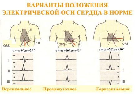 Eos (електрически ос на сърцето) и отклонение на позиция