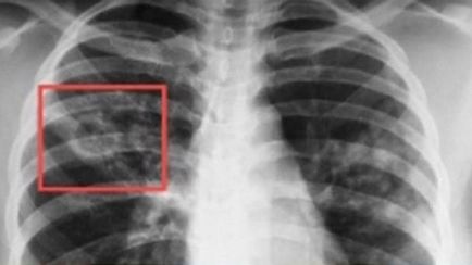 Рентгенография на гръдния кош светлина - какво е необходимо и какво показва