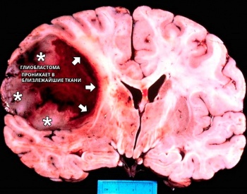 Brain глиобластом, симптоматика и степента на набъбване, възможности за лечение на