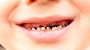 Rotten зъби - снимки, защо те гният от вътре и какво да правят,
