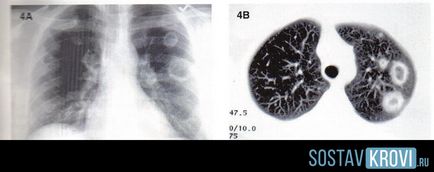грануломатоза на Вегенер причинява симптомите, диагностициране, лечение и прогноза