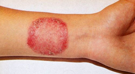 Гъбични болестни симптоми кожата и лечение 1