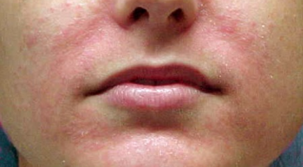 Гъбични болестни симптоми кожата и лечение 1
