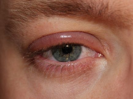 Инфекциозни заболявания на окото