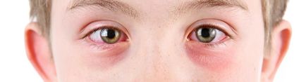 Инфекциозни заболявания на окото