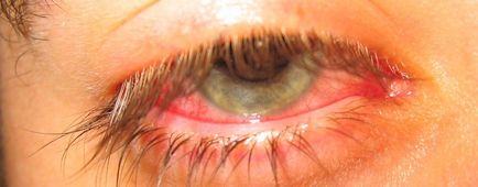 Инфекция симптоми на око