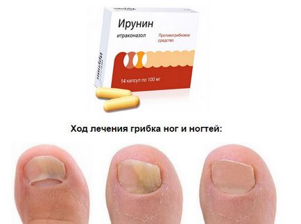 Irunine ревюта, инструкции за употреба с гъбички на ноктите, противопоказания, цена