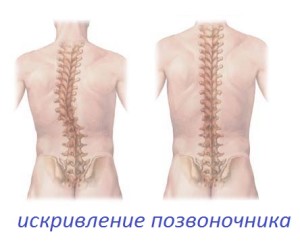 изкривяване на гръбначния стълб - как да се лекува симптомите, хиропрактика