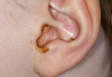 Ухото е оцветена в жълто течност, отколкото лечение