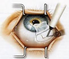 Какви видове операция на очите