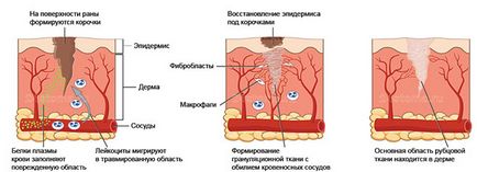 Как да се отървем от белези след варицела, местни продукти, козметични процедури