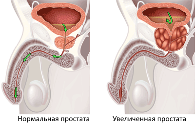 Как за лечение на ДПХ у дома