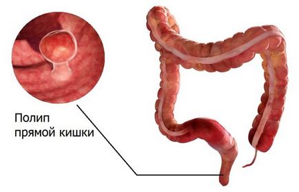 Как за лечение на полипи в съветите ректума и трикове