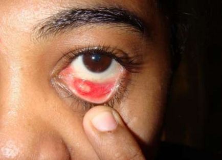 Как за лечение на ечемик на окото на долния клепач (вътрешна)