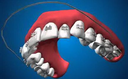 Как тиранти, статии за деца ортодонтия