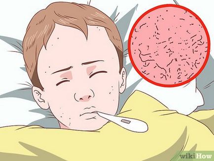 Как да разпознаете симптомите на менингит