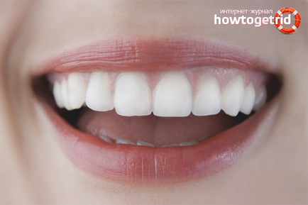 Как да се съгласуват зъбите у дома
