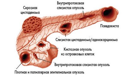 Киста на симптомите на стомаха и признаци