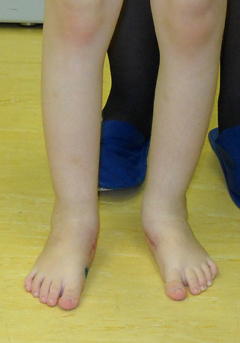 Комплексното лечение ploskovalgusnoy крак деформации, Шри рехабилитационен център Педиатрия