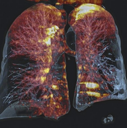 Компютърна томография на белите дробове, същността на метода, показания, противопоказания относителна сравнение с