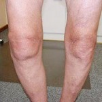 Контрактура коляното за лечение на коляното