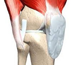 Контрактура на коляното - причини, симптоми, диагностика и лечение