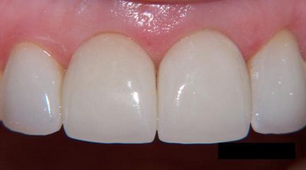 Корони за зъби, пациентите предните цена и мнения