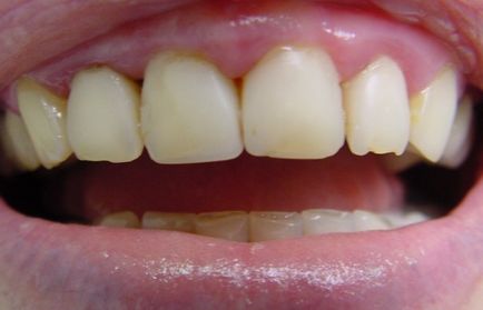 Корони за зъби, пациентите предните цена и мнения